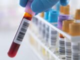 "Rare Blood Group Discovery: Rajkot Man Becomes 11th Known Case Worldwide"